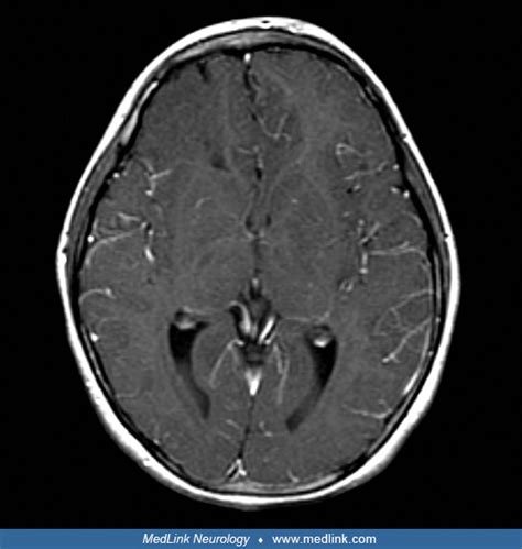 Polymicrogyria | MedLink Neurology