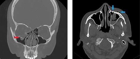 a, b. Coronal CT scan shows blow-out fracture on the right side (red... | Download Scientific ...