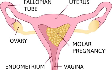 Hydatidiform Mole : Overview, Causes, Symptoms, Treatment - illness.com