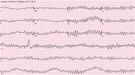 Ventricular fibrillation