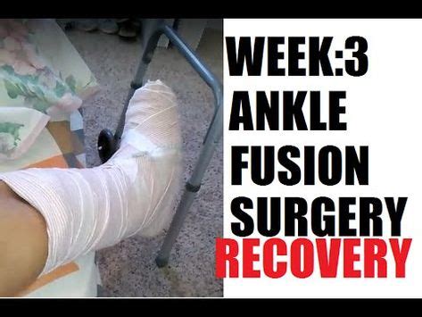 Week 2: Ankle Fusion Surgery Recovery - YouTube | Ankle surgery, Surgery recovery, Surgery