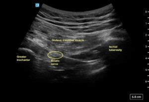 Ultrasound Guided Transgluteal Sciatic Nerve Block for Refractory Sciatica in the Emergency ...