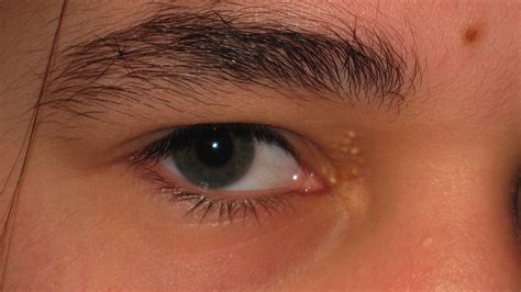 Treatment for lump inside eyelid, chalazion, eyelid cyst | Mr David ...