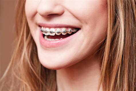 FAQs About Traditional Braces’ Colors in Roseville, CA