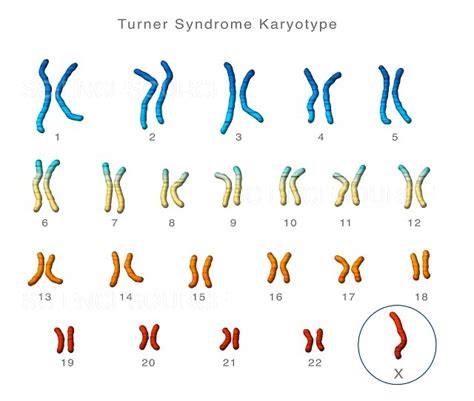 Turners Syndrome