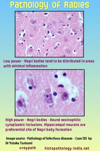 Pathology Of Negri Bodies Dr Sampurna Roy Md | Free Download Nude Photo ...