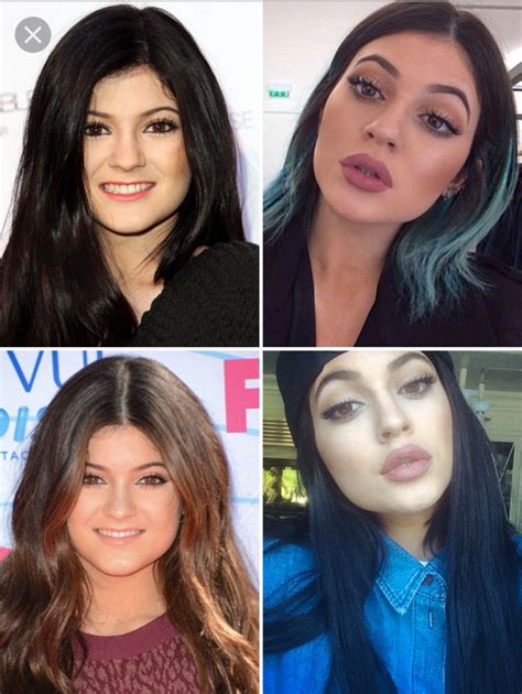 Kylie Jenner before and after #LipFillersIdeas | Botox lips, Lip fillers, Kylie