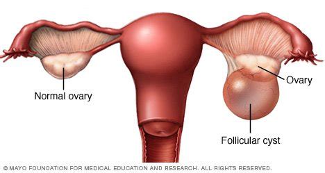 Ovarian cysts Disease Reference Guide - Drugs.com