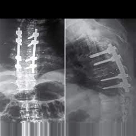 X-ray Dorsal Lumbar Spine AP/Lat | Test Price in Delhi | Ganesh Diagnostic