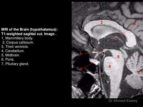 MRI imaging hypothalamus Dr Ahmed Esawy