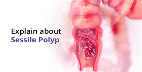 Sessile Polyp Symptoms, Diagnosis & its Treatment | Birla Fertility & IVF