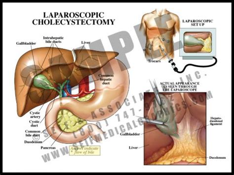 Cholangiography - S&A Medical Graphics