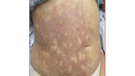 Mottled Skin (Livedo Reticularis): Causes, Signs, and Treatment