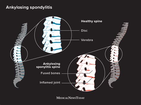 Ankylosing Spondylitis