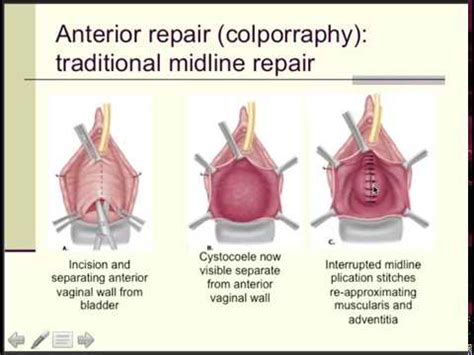 Pelvic Floor Repair Mesh Plications - Carpet Vidalondon