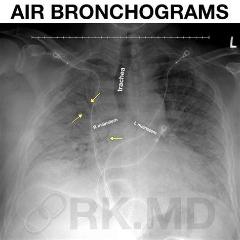 Air Bronchograms | RK.MD