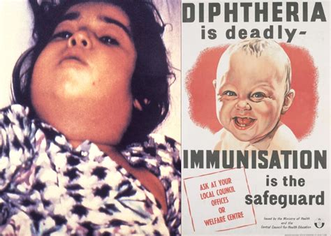 Here's what you should know about the Diphtheria outbreak | Economy24