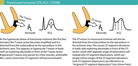 ECG in myocardial ischemia: ischemic changes in the ST segment & T-wave – Cardiovascular Education