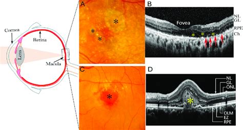 Clinical features of late stages of AMD. (A, B) "dry" AMD (Geography... | Download Scientific ...