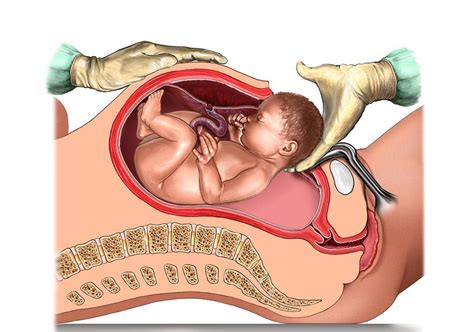 Worrying Rise in Caesarean Section Deliveries - Any Ulterior Motive at ...