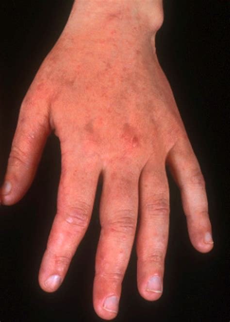 Irritant Contact Dermatitis | Occupational Dermatology