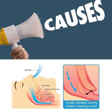 What causes snoring? - Snore Doc