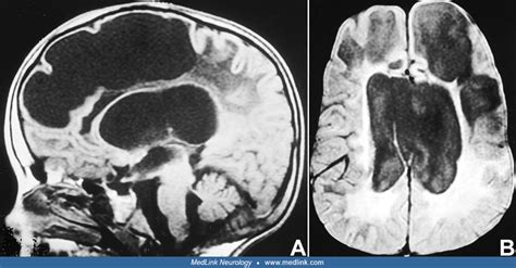 Alexander disease | MedLink Neurology