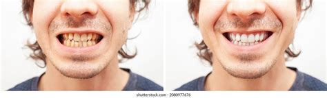 Close Portrait Smile Teeth Man Before Stock Photo 2080977676 | Shutterstock