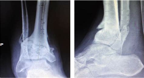 A) X-ray(AP) of comminuted, high-energy pilon fracture, with continued... | Download Scientific ...