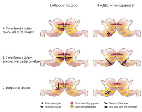 Summary schematic diagram of post ablation slow wave activation ...