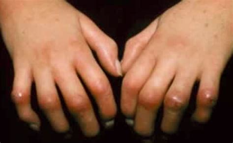 Diagnosis: Scleroderma Diagnosis