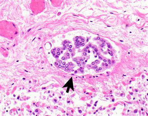 Epithelioid Mesothelioma Pathology Outlines - Goimages 411