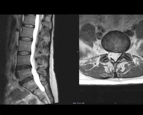 Lumbar Spine Mri Bulging Disc