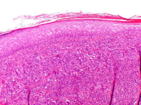 Malignant Fibrous Histiocytoma (undifferentiated pleomorphic sarcoma, not otherwise specified ...