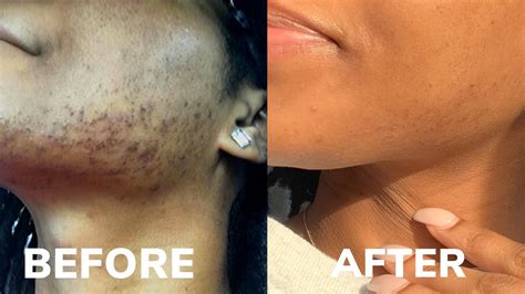 Is Chin Laser Hair Removal Worth It | Lipstutorial.org