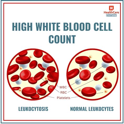 Leukocytosis (High WBC) - Types, Causes, Symptoms, Treatment