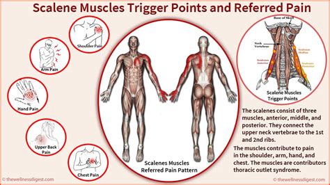 Scalene Muscles: Neck, Shoulder, Chest, Upper Back, Arm, Pain - The Wellness Digest