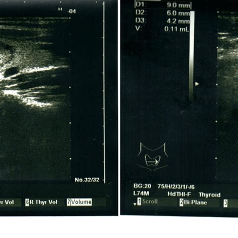 Ultrasound examination of patient before and after treatment of ...