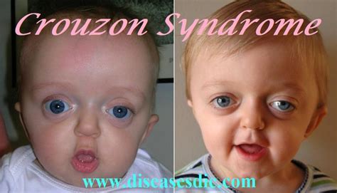 Crouzon Syndrome - Symptoms, Treatment, and Prevention