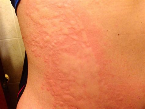 Severe case of hives | Health and Fitness | Pinterest | Doctors ...