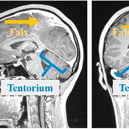 Falx and Tentorium in iUS images showing their different representation ...