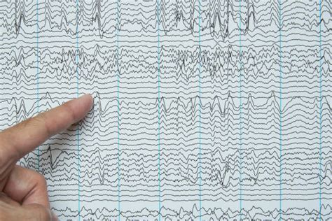 Epilepsy Brain Waves Stock Photos, Pictures & Royalty-Free Images - iStock