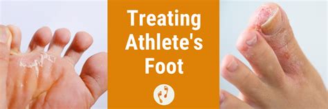 Treating Athlete's Foot This Summer | Masterton Podiatrist