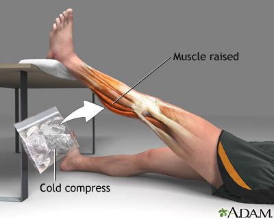 Muscle strain treatment | UF Health, University of Florida Health