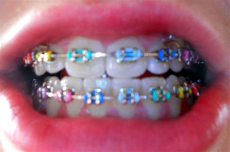 Braces colors, Rainbow braces, Teeth braces