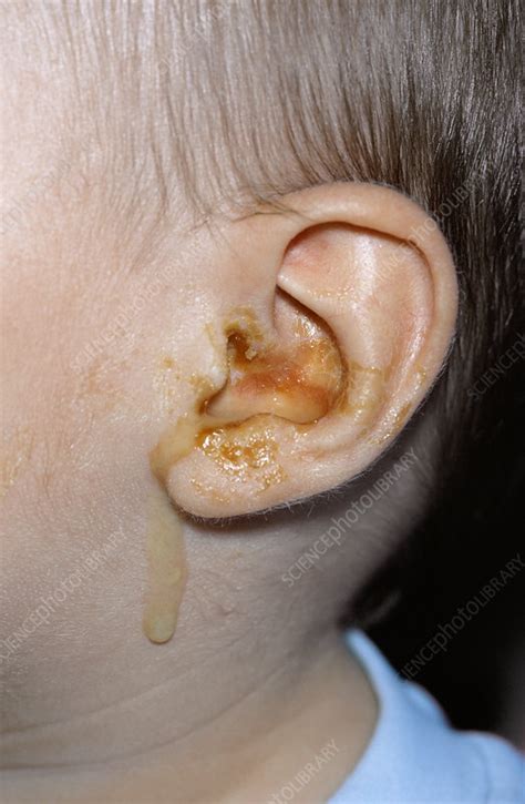 Otitis media infection - Stock Image - M157/0058 - Science Photo Library