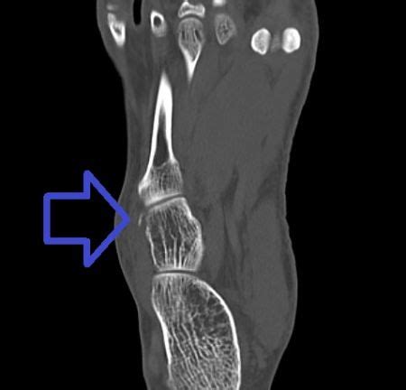 Cuboid fracture - WikEM