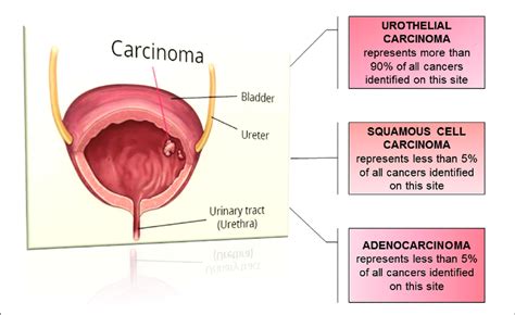 Histological types of bladder cancer. | Download Scientific Diagram