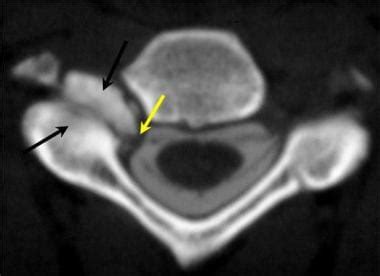 Spinal Stenosis: Practice Essentials, Anatomy, Pathophysiology