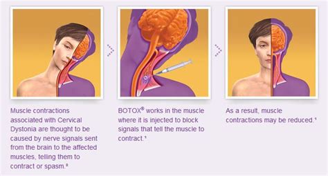 Botox for Chronic Migraines/Cervical Dystonia – Interventional Spine ...